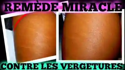 Vendeur Crème Anti Vergéture à Dakar à Dakar - Vue 1