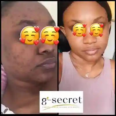 Pack Réparateur (acnés Taches Peau Grasse) à Dakar - Vue 1